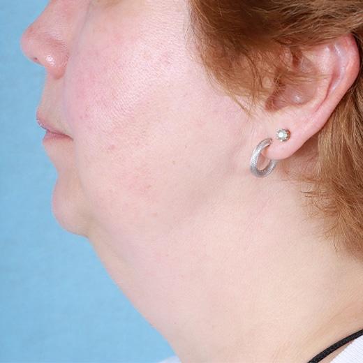 Neck Lift before at Aesthetic Center at Woodholme in Baltimore, MD