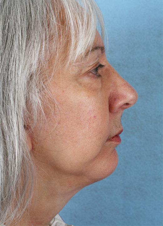 Aesthetic Center at Woodholme facelift after — Baltimore, MD