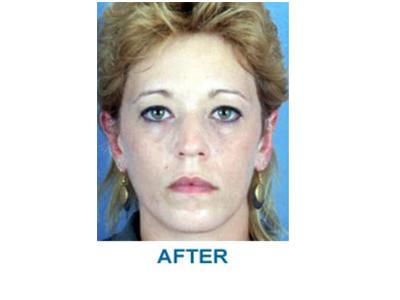 Aesthetic Center at Woodholme otoplasty after — Baltimore, MD