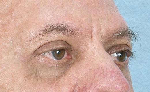 Blepharoplasty after at Aesthetic Center at Woodholme in Baltimore, MD