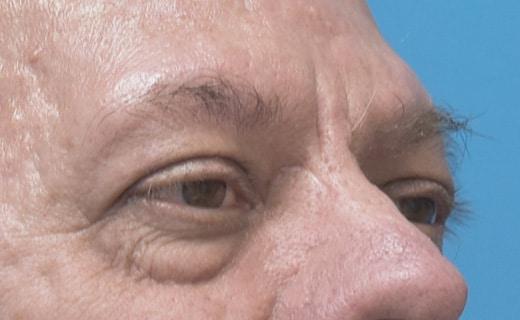 Blepharoplasty before at Aesthetic Center at Woodholme in Baltimore, MD