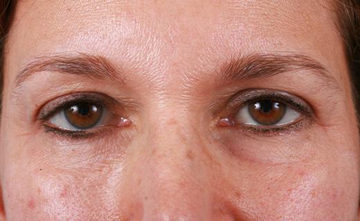 Blepharoplasty after at Aesthetic Center at Woodholme in Baltimore, MD