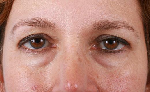 Blepharoplasty before at Aesthetic Center at Woodholme in Baltimore, MD