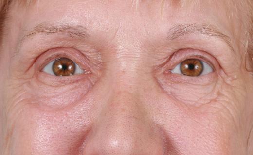 Blepharoplasty after at Aesthetic Center at Woodholme in Baltimore, MD