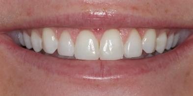 Gum Contouring after at Elghor Dental Studio: Sarah Elghor, DDS in San Diego, CA