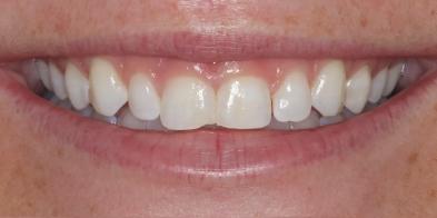 Gum Contouring before at Elghor Dental Studio: Sarah Elghor, DDS in San Diego, CA