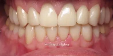 Elghor Dental Studio: Sarah Elghor, DDS veneers after — San Diego, CA