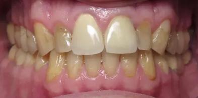 Dental Veneers before at Elghor Dental Studio: Sarah Elghor, DDS in San Diego, CA