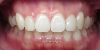 Elghor Dental Studio: Sarah Elghor, DDS invisalign after — San Diego, CA