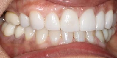 Smile Makeover after at Elghor Dental Studio: Sarah Elghor, DDS in San Diego, CA