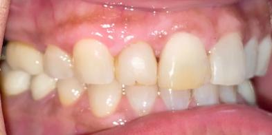 Smile Makeover before at Elghor Dental Studio: Sarah Elghor, DDS in San Diego, CA