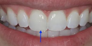 Elghor Dental Studio: Sarah Elghor, DDS smile makeover after — San Diego, CA