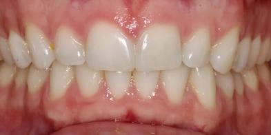 Elghor Dental Studio: Sarah Elghor, DDS smile makeover after — San Diego, CA