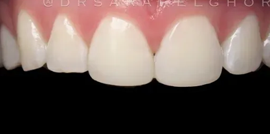 Elghor Dental Studio: Sarah Elghor, DDS smile makeover after — San Diego, CA