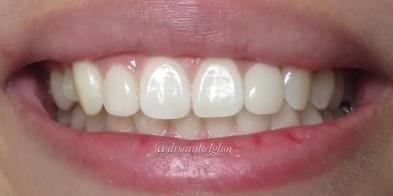 Elghor Dental Studio: Sarah Elghor, DDS invisalign after — San Diego, CA