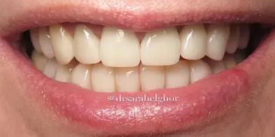 Elghor Dental Studio: Sarah Elghor, DDS veneers after — San Diego, CA