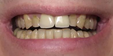 Dental Veneers before at Elghor Dental Studio: Sarah Elghor, DDS in San Diego, CA