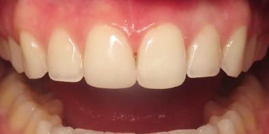 Smile Makeover after at Elghor Dental Studio: Sarah Elghor, DDS in San Diego, CA