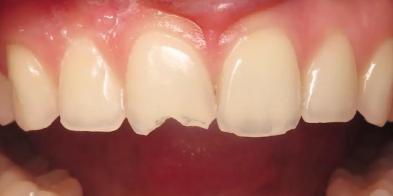 Smile Makeover before at Elghor Dental Studio: Sarah Elghor, DDS in San Diego, CA