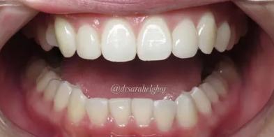 Invisalign after at Elghor Dental Studio: Sarah Elghor, DDS in San Diego, CA