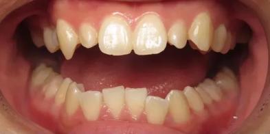 Invisalign before at Elghor Dental Studio: Sarah Elghor, DDS in San Diego, CA