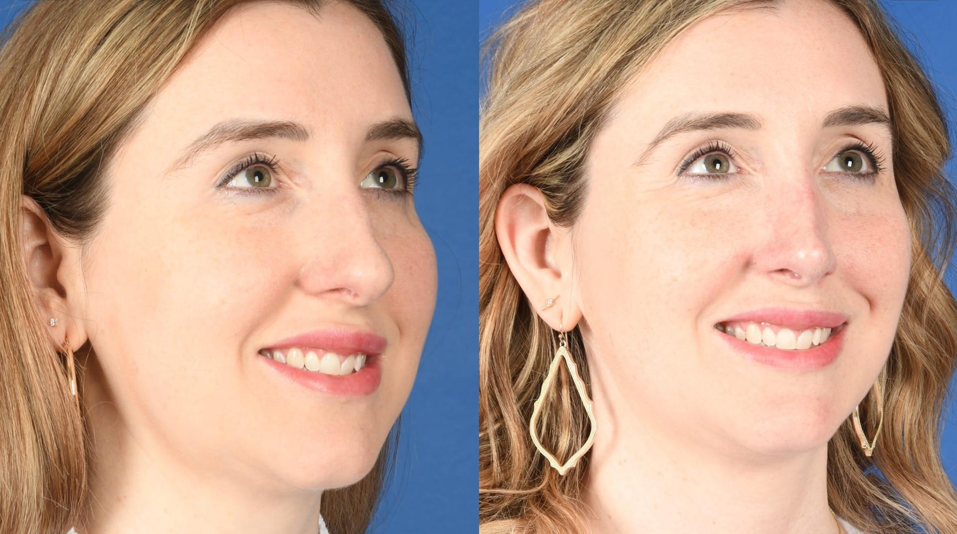 Southlake Plastic Surgery rhinoplasty result — Southlake, TX