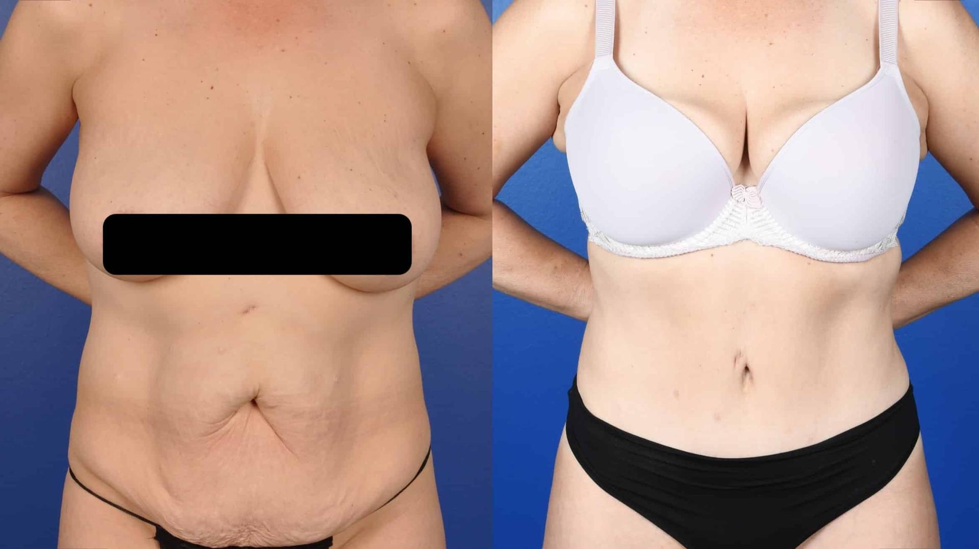 Southlake Plastic Surgery liposuction result — Southlake, TX