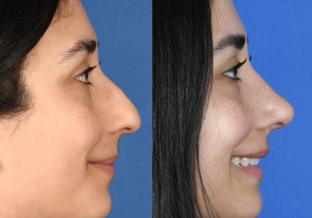 Liquid Rhinoplasty result at Southlake Plastic Surgery in Southlake, TX