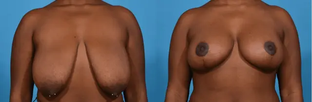 Breast Reduction result at Southlake Plastic Surgery in Southlake, TX