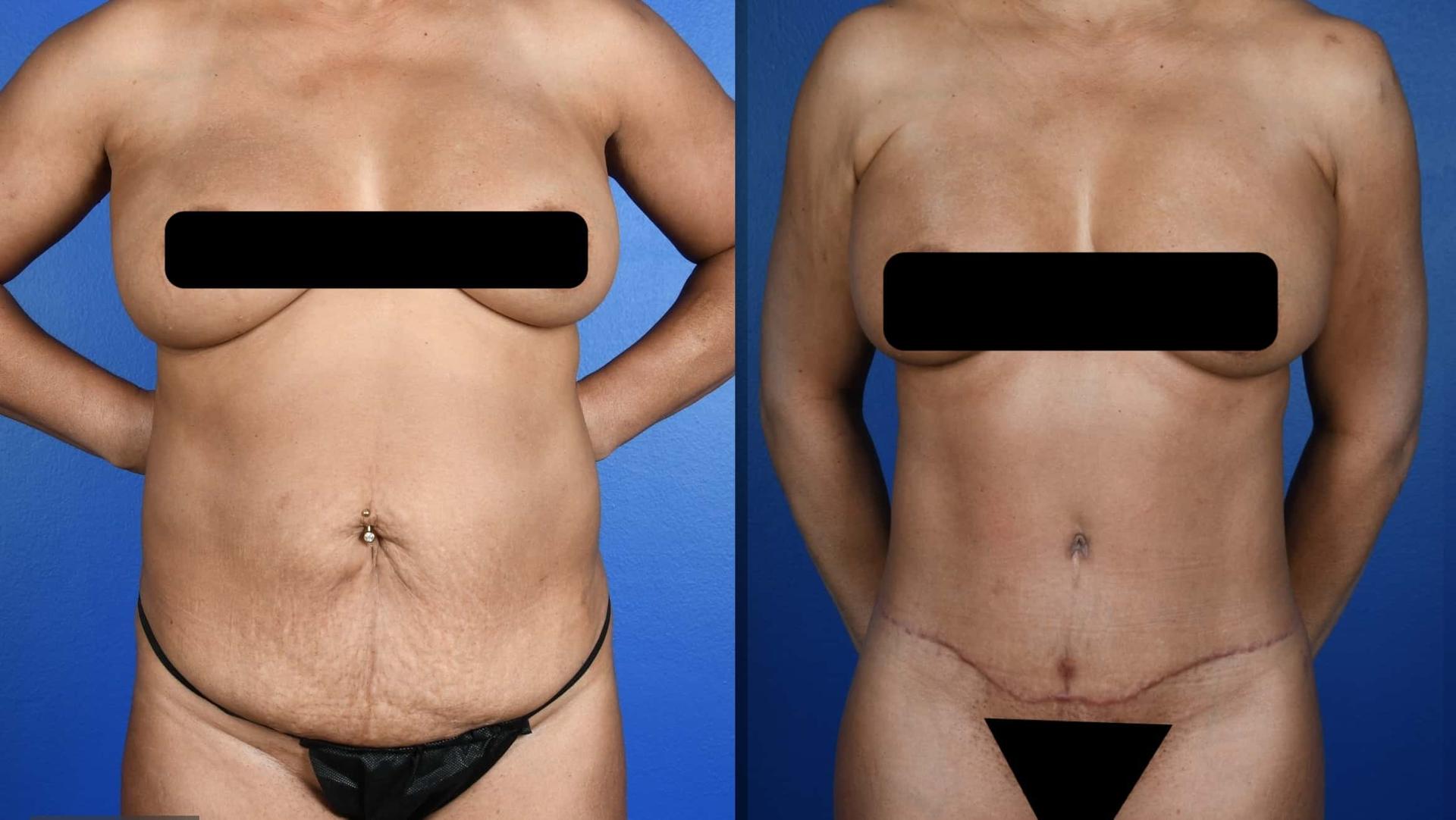 Southlake Plastic Surgery liposuction result — Southlake, TX