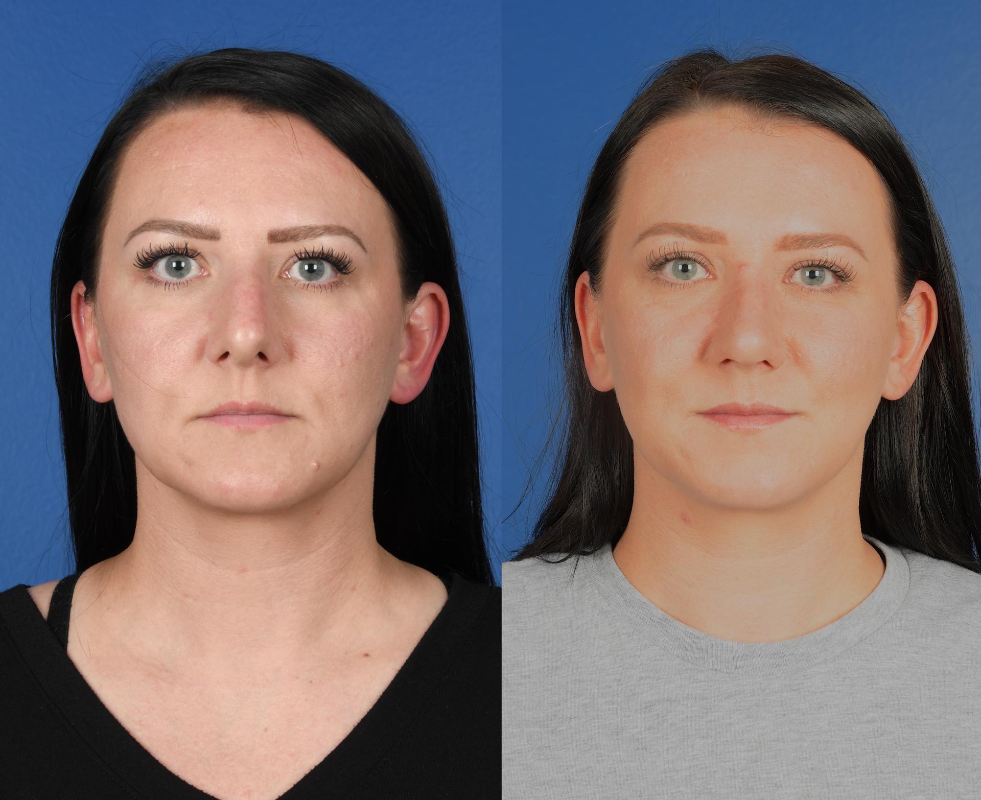 Southlake Plastic Surgery rhinoplasty result — Southlake, TX