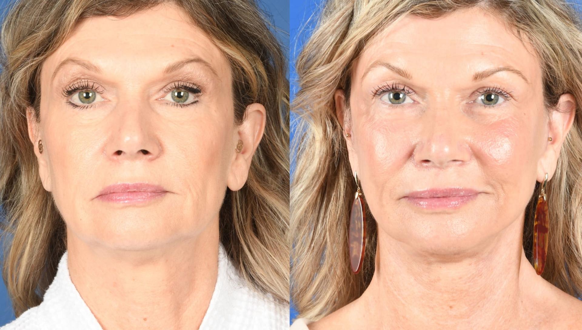 Southlake Plastic Surgery facelift result — Southlake, TX