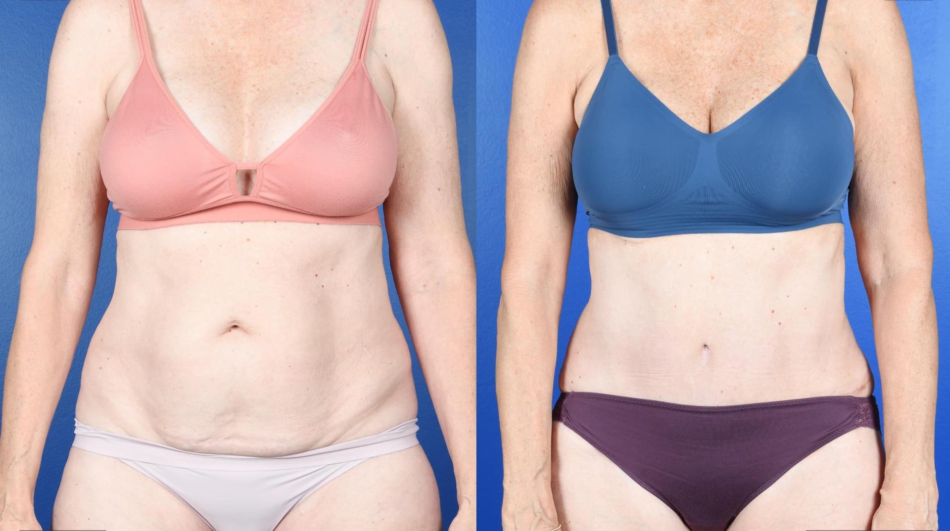 Southlake Plastic Surgery liposuction result — Southlake, TX