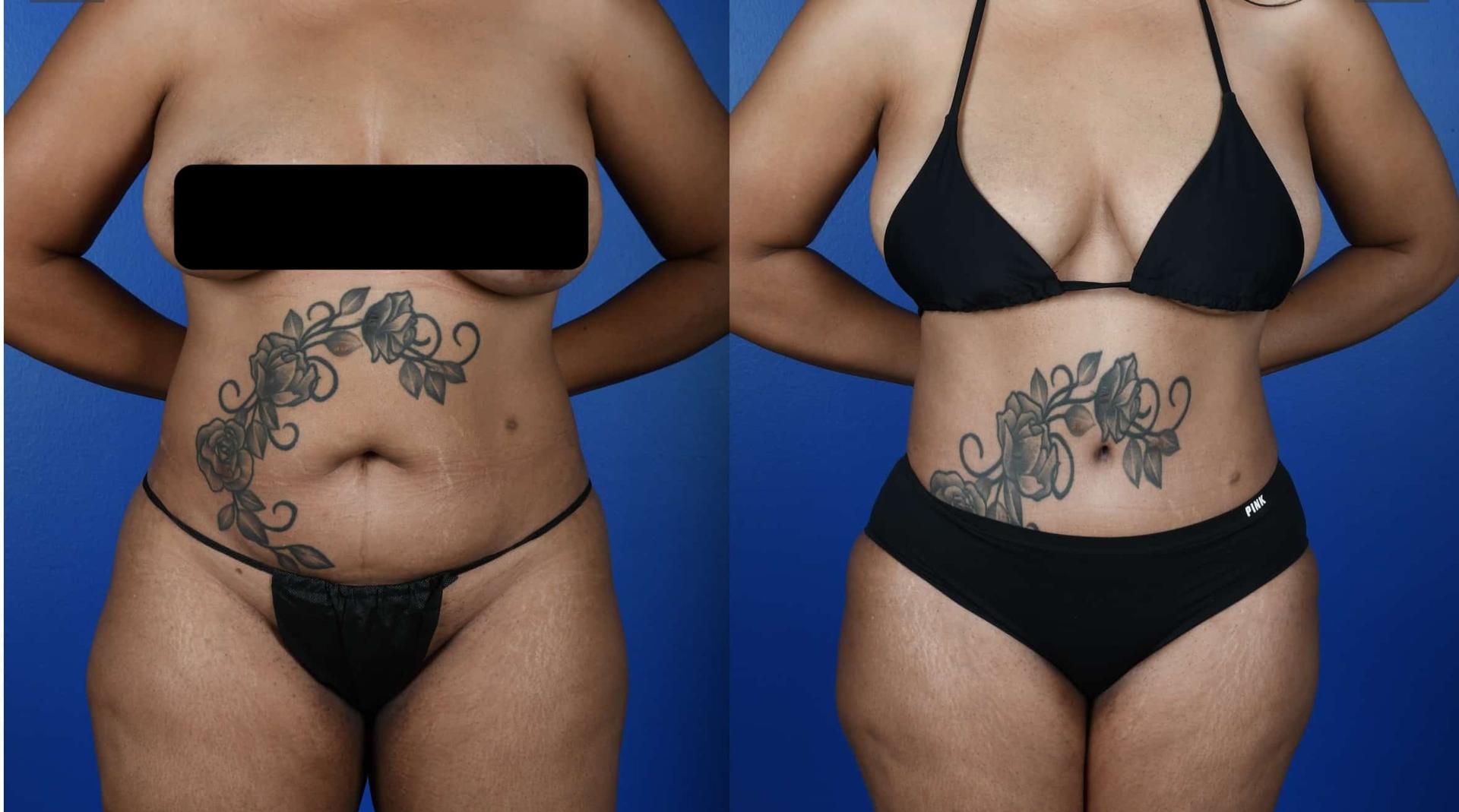 Southlake Plastic Surgery liposuction result — Southlake, TX