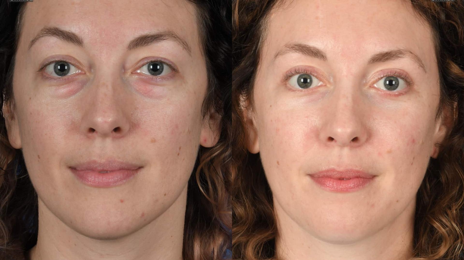Southlake Plastic Surgery blepharoplasty result — Southlake, TX