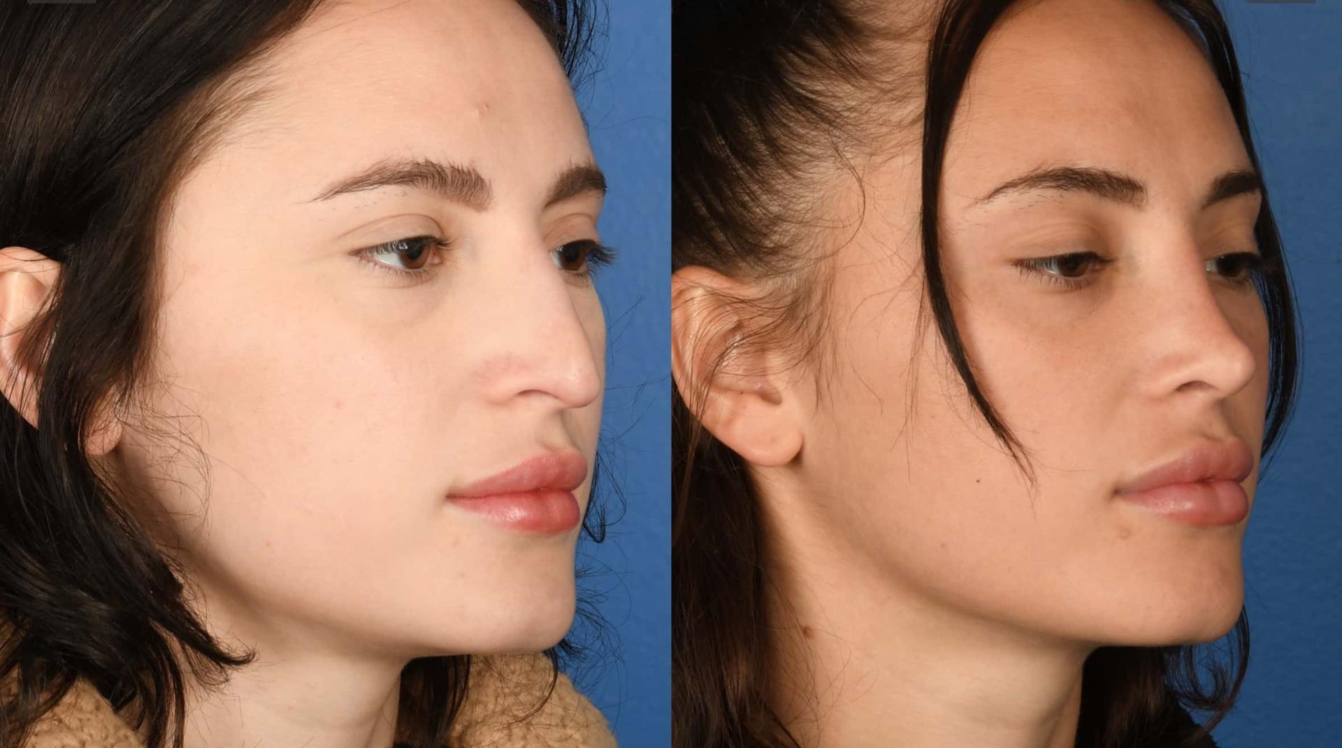 Southlake Plastic Surgery rhinoplasty result — Southlake, TX