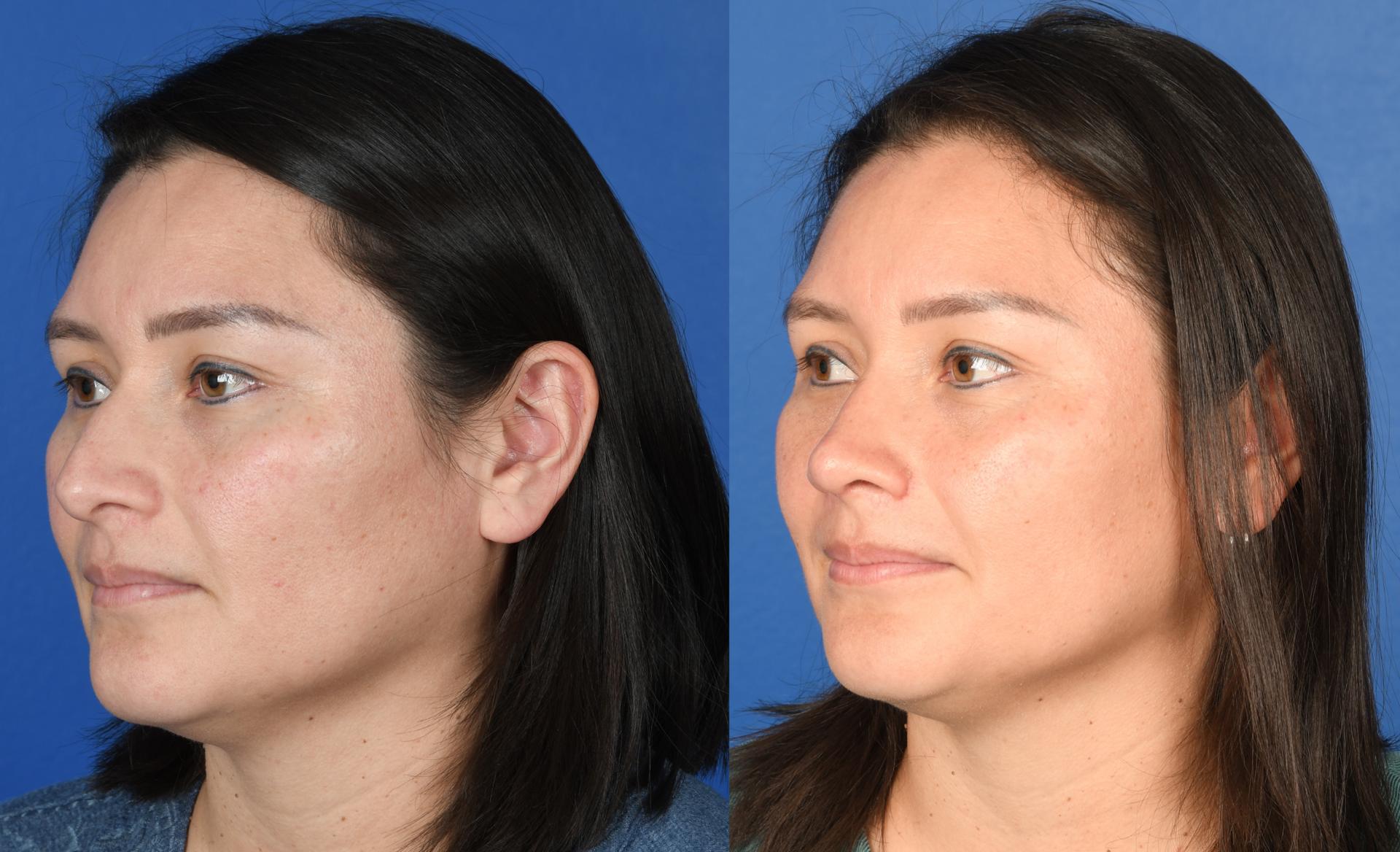 Southlake Plastic Surgery rhinoplasty result — Southlake, TX