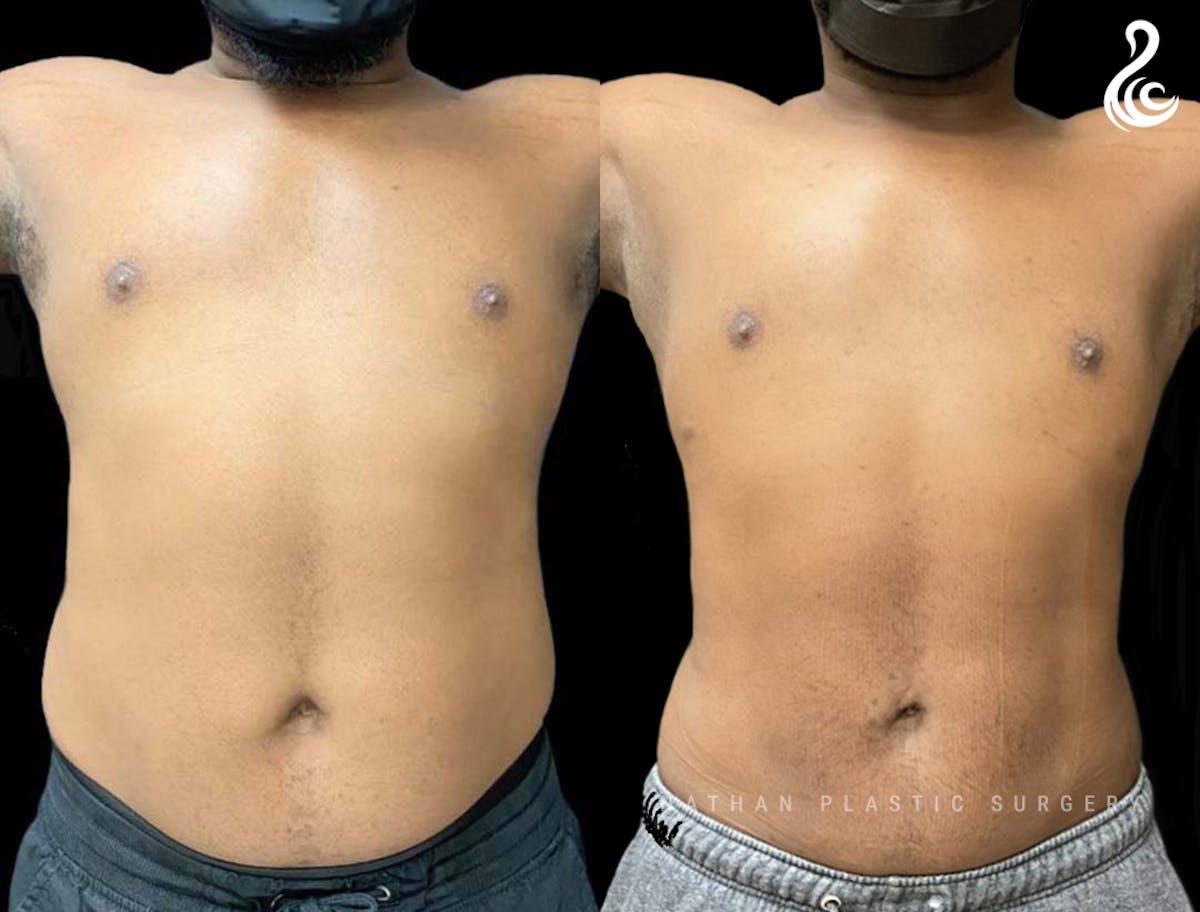 Dr. Nathan liposuction result — Miami, FL