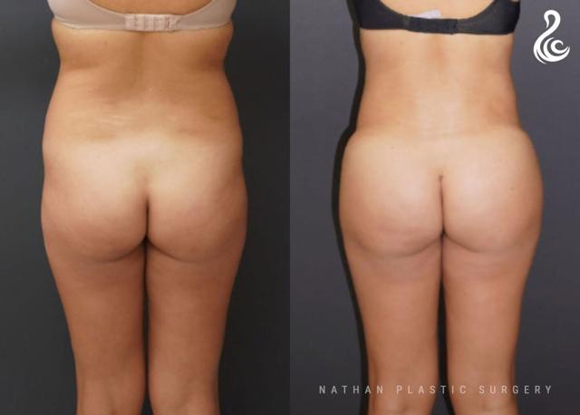 Brazilian Butt Lift result at Dr. Nathan in Miami, FL