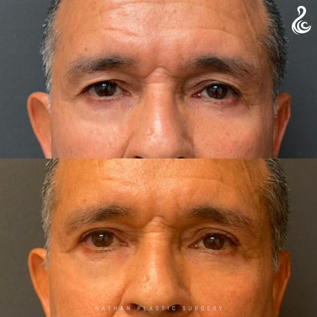 Blepharoplasty result at Dr. Nathan in Miami, FL