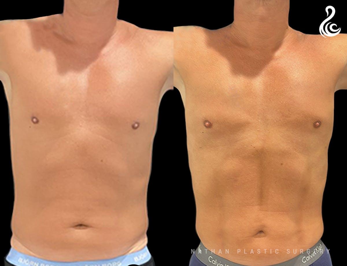 Dr. Nathan liposuction result — Miami, FL