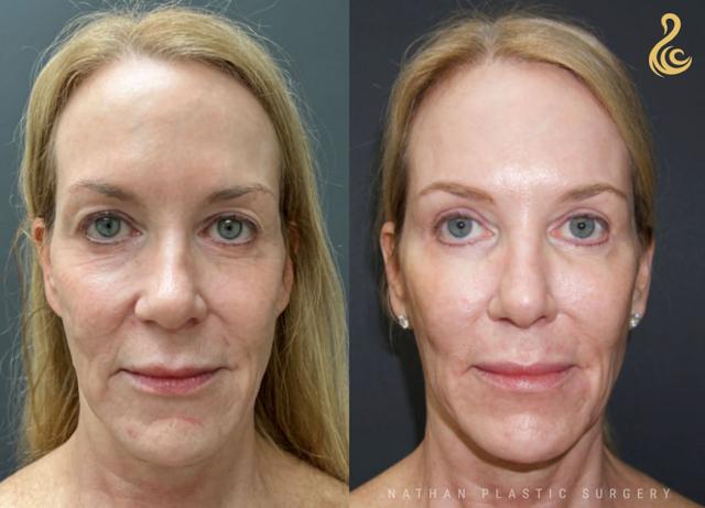 Facelift result at Dr. Nathan in Miami, FL