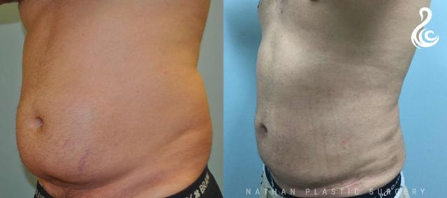 Liposuction result at Dr. Nathan in Miami, FL