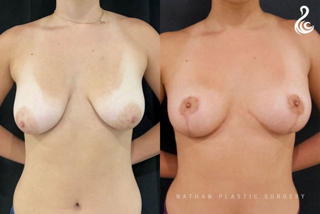 Breast Lift result at Dr. Nathan in Miami, FL