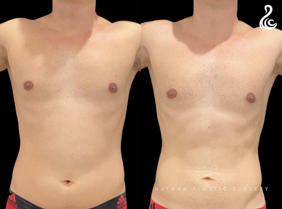 Dr. Nathan liposuction result — Miami, FL