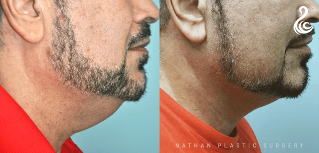 Neck Lift result at Dr. Nathan in Miami, FL