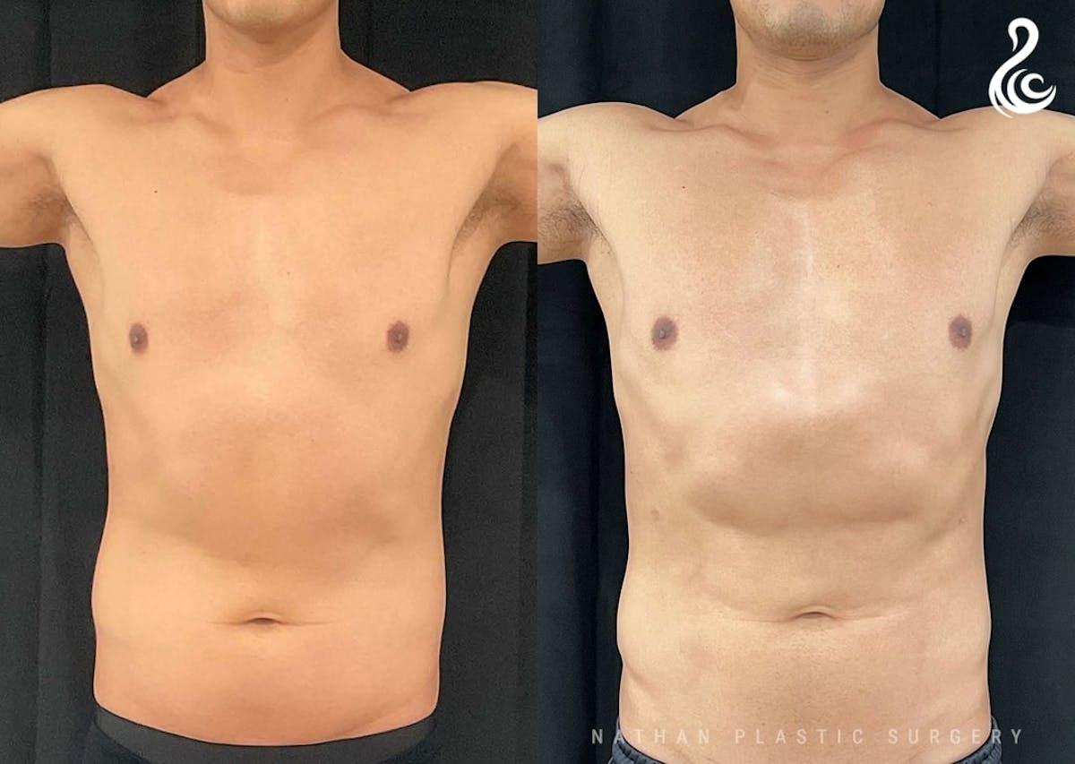 Dr. Nathan liposuction result — Miami, FL