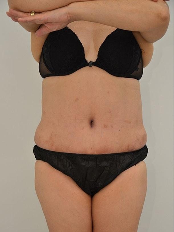 Pacific Plastic Surgery Group (Edward P. Miranda, MD) tummy tuck after — San Francisco, CA
