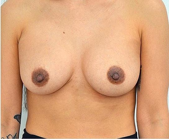Pacific Plastic Surgery Group (Edward P. Miranda, MD) breast augmentation after — San Francisco, CA