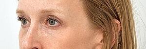 Pacific Plastic Surgery Group (Edward P. Miranda, MD) eyelid lift after — San Francisco, CA